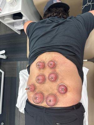 Cupping by Mrs. Michelle Collins