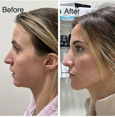 Cheek and jawline filler