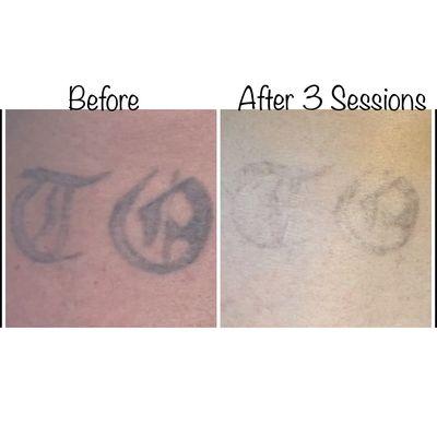 Laser tattoo removal