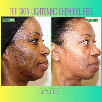 Medical strength skin lightening face and/or body peel. 3 easy steps application, less than 30 min. Dramatic improvement in skin