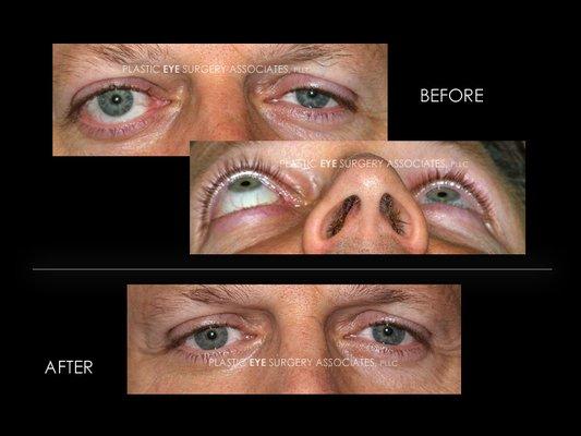 EYELID SURGERY POST ORBIT DECOMPRESSION