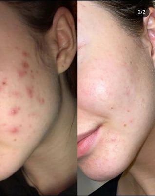 Stop suffering from Acne. I can help you!