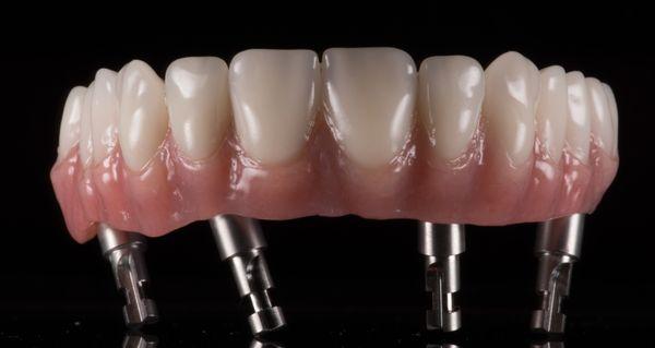 vhnow (immediate load concept) is your solution to full mouth reconstruction.