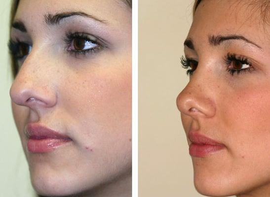 rhinoplasty