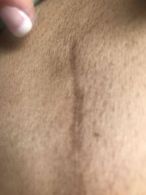 Scar before treatment