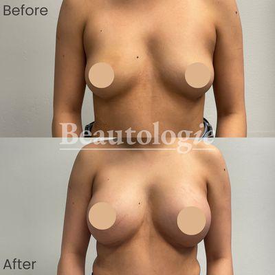 Bilateral Breast Augmentation with 400ml Saline Implants Before and After