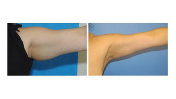 Before and after Ultrasonic Cavitation