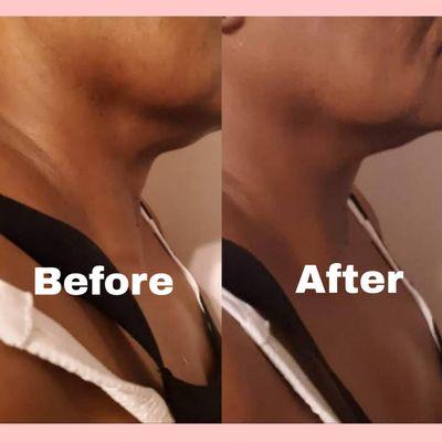 non surgical double chin removal