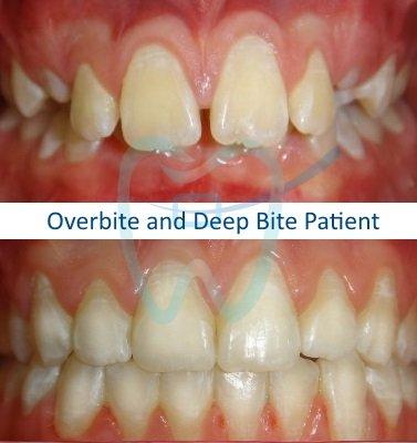 Overbite and Deep Bite Patient