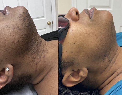 Before and after - Face laser hair removal