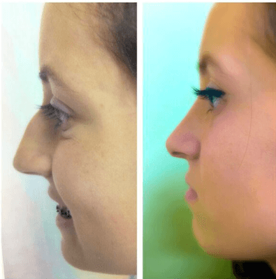 Rhinoplasty, Before & After