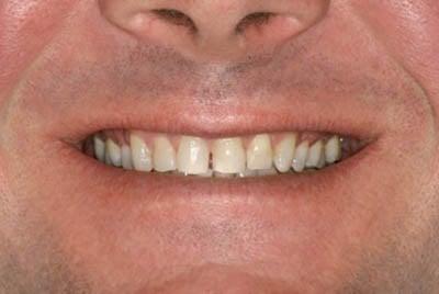 Dallas Teeth Whitening