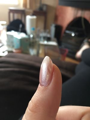 Dents in acrylic nails