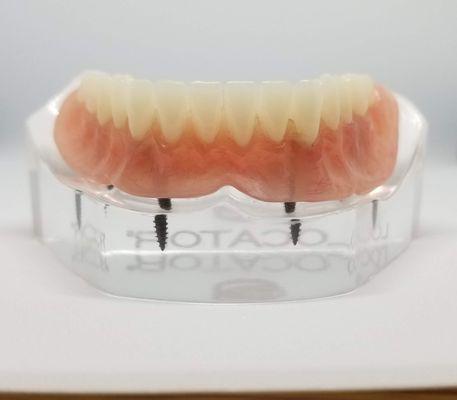 "Snap-in" implant dentures - these offer advantages over regular dentures - eat more foods, speak more easily, less bone loss