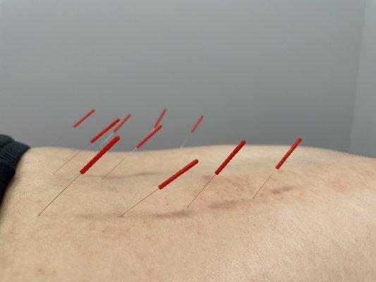 Acupuncture session for lower back pain