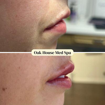 Lip filler with Restylane Kysse