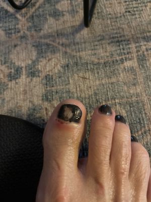 Damaged cuticle from pedicure by Nina