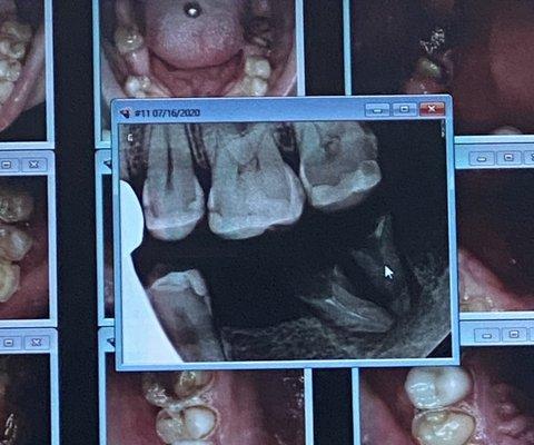 Dental rad and pictures