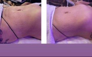 Radiofrequency,
cavitation and wood Therapy.