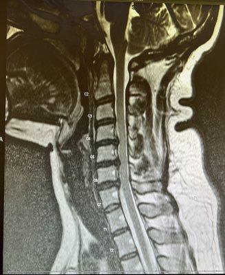 Cervical herniation