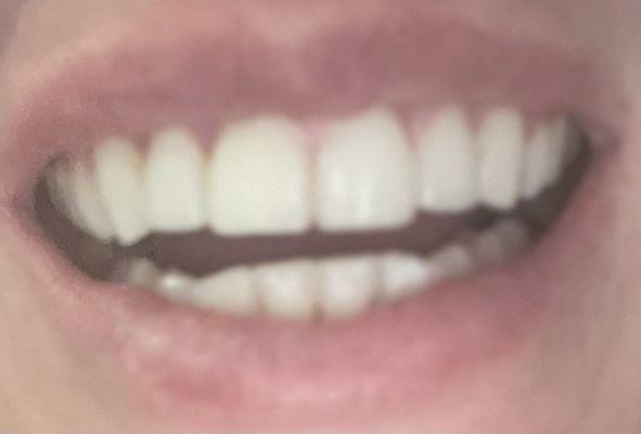 My fixed tooth