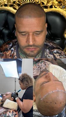 Before and after Scalp micropigmentation (SMP) feeling confident again.