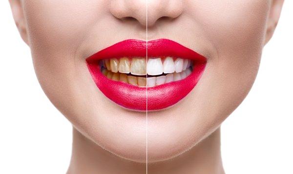 One hour teeth whitening can change your life. Fall in love with your 1-hour teeth whitening treatment. #pembrokepines #teeth #withening #te