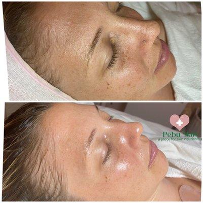 Repair Replenish Regenerate with skin identical ingredients. No dermaplaning ,no acid peel. after one treatment.