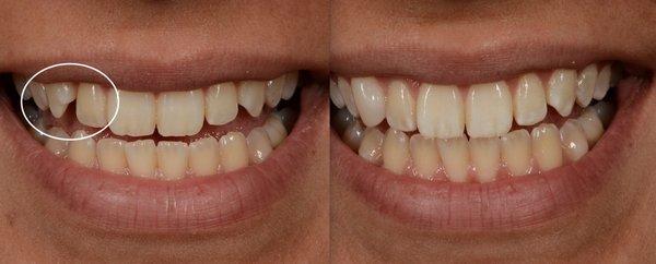 Prominent canine teeth (eye teeth) are a common problem that may be corrected in 1 visit "without filing down teeth" with ProVeneers.