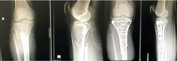 Complex tibial plateau fracture  before and after restoration of anatomy