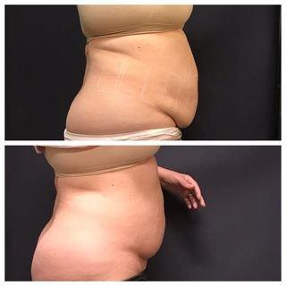 Ask us about SculpSure