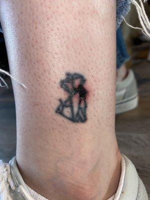 Ruined Tattoo from Laser Hair Removal