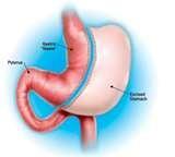 Sleeve Gastrectomy Surgery