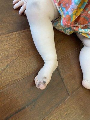 My daughter's feet after 15 min