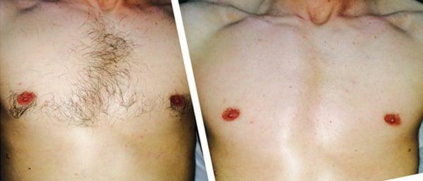 Chest wax before & after