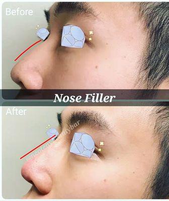 Nose filler