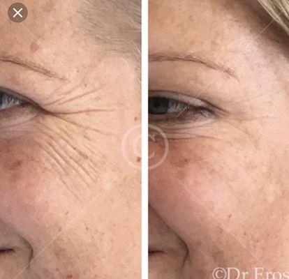 Crows feet reduction