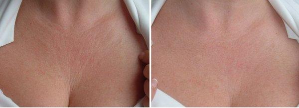 Décolletage wrinkles reduction