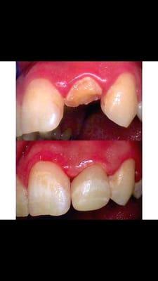 Before & after:  Patient had a broken front tooth emergency. We fixed it w/ a custom stained same day EMax crown.