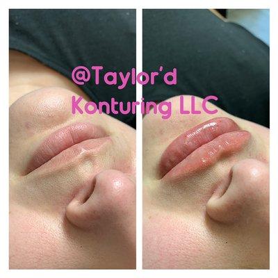 Lip Fillers are now available @taylordkonturingllc