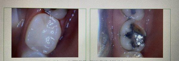 Left side is how my tooth looks now, right side is how it started.