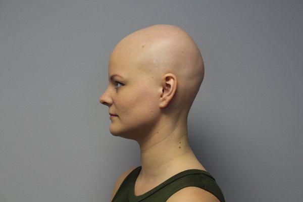 We help Alopecia Guests with our Duplication Systems: Before