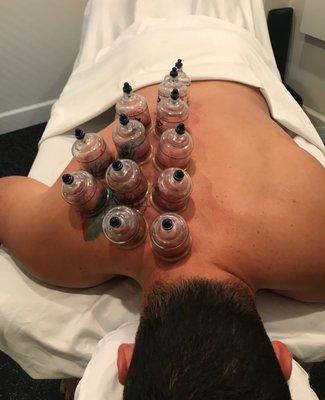 Cupping