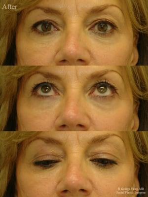 55 yo woman: Restylane injections to blend away her eyebags by filling her tear troughs & orbital rim hollow and lift her cheek.