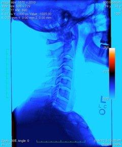 Prolotherapy helps chronic neck pain