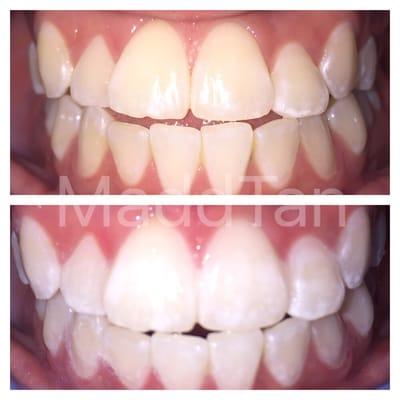 1hr plant based teeth whitening!