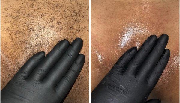 Brazilian sugaring