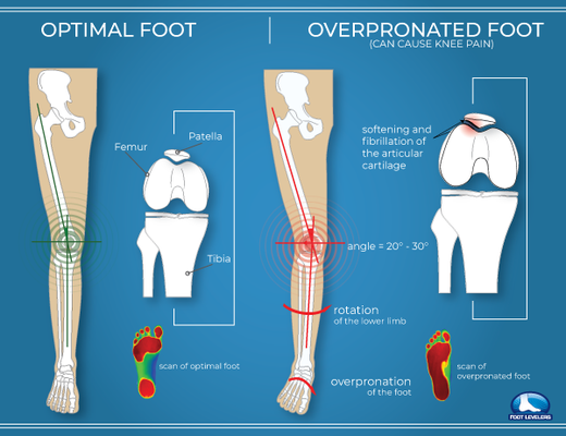 Over pronation affects your entire body, we can help.