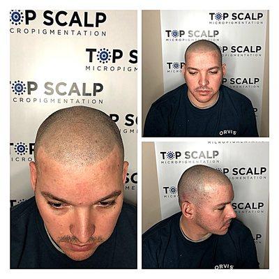 Top Scalp Micro