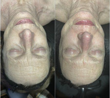 Anti-Aging Facial